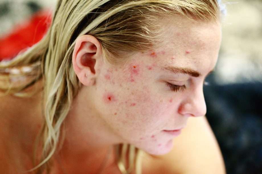 Are you suffering from hormonal acne?
