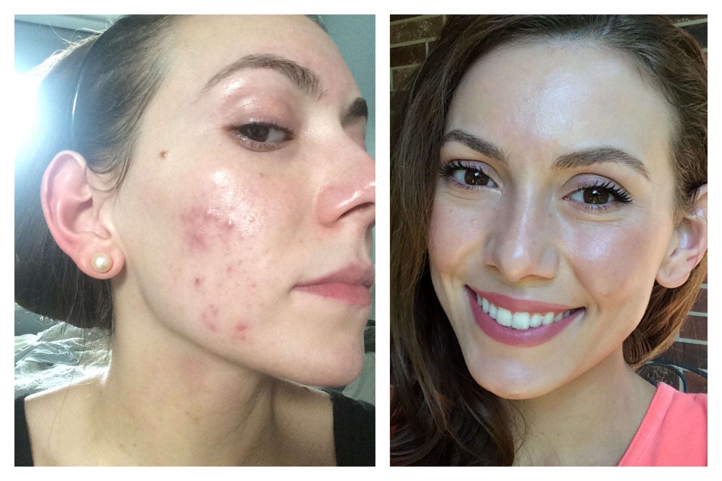 [Before& After] 6 months of hormonal acne treatment later ...