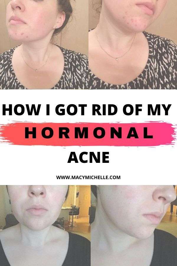 How I Cleared Up My Hormonal Acne