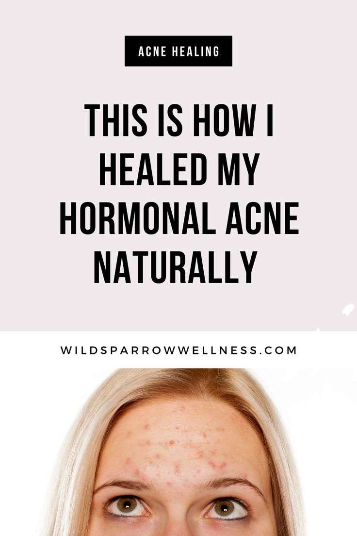 How I Naturally Healed My Hormonal Acne in 2020