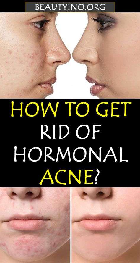 How to Get Rid of Hormonal Acne? in 2020