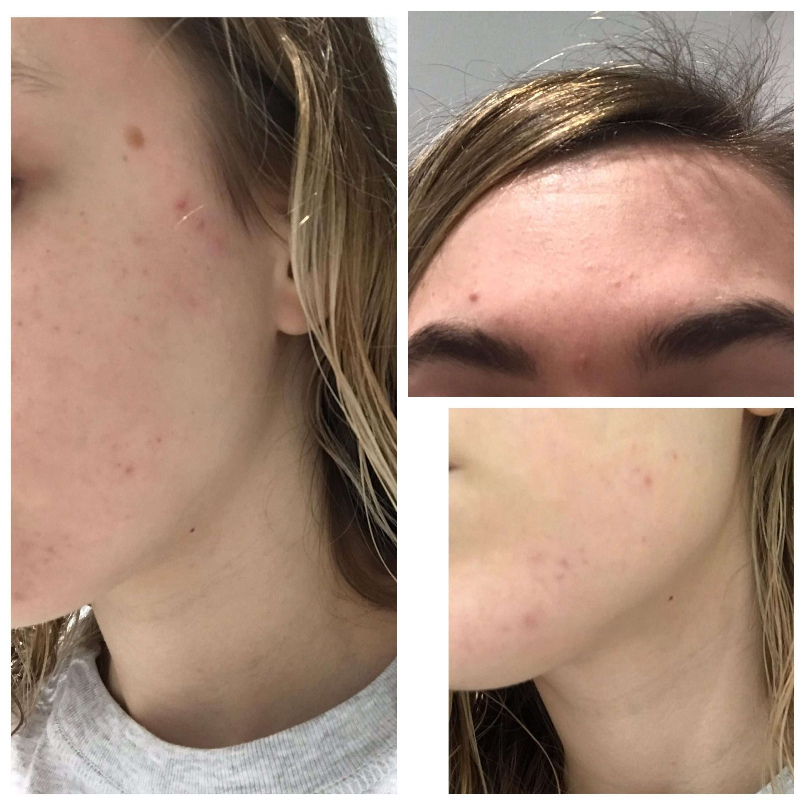 How to help hormonal acne/whatever this is? : acne