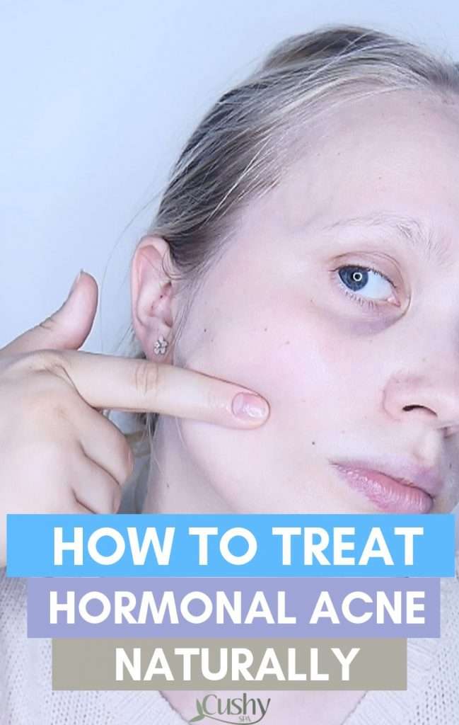How to Treat Hormonal Acne Naturally: 8 Treatments