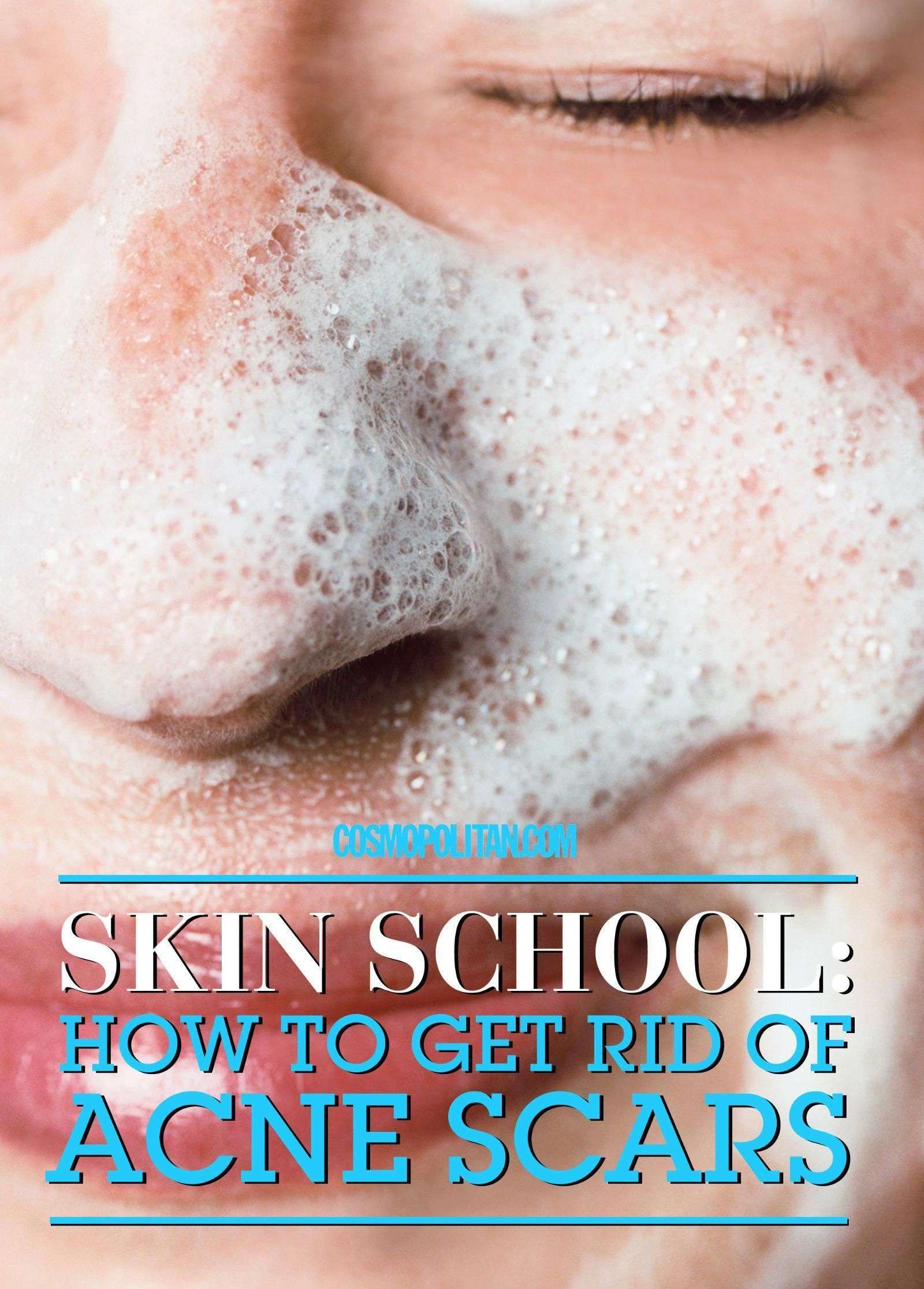 Pin on How to Get Rid of Painful Acne Scars Fast