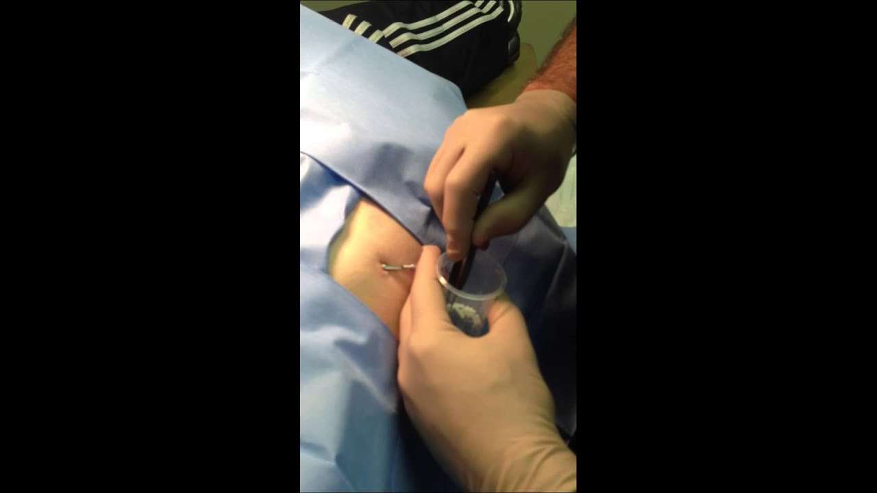 Testopel Insertion. Testosterone pellet treatment and trp ...